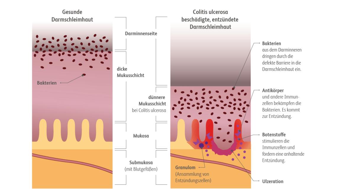 Entzündete Dickdarmschleimhaut bei Colitis Ulcerosa im Vergleich zur gesunder Dickdarmschleimhaut.